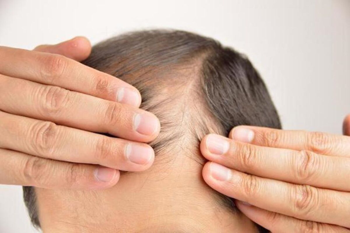 داروهای ریزش موی مناسب کدامند؟ چگونه ریزش مو را درمان می‌کنند؟
