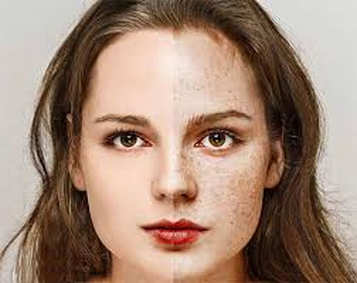 لکه ها قهوه ای پوست را چگونه از بین ببریم؟