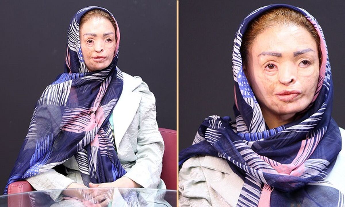 چهره هولناک دختر تبریزی همه را ترساند