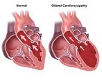 آیا گشادی دریچه قلب خطرناک است؟