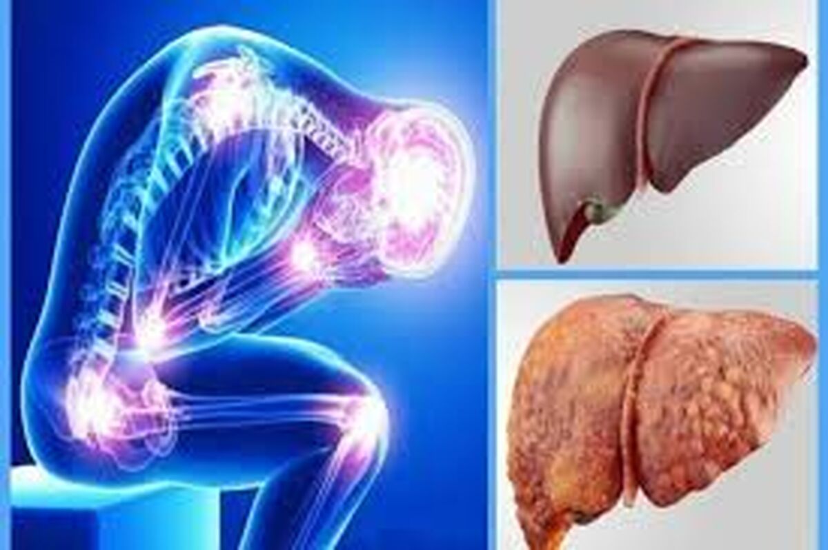 چرا مبتلایان به کبد چرب جان خود را از دست می دهند؟