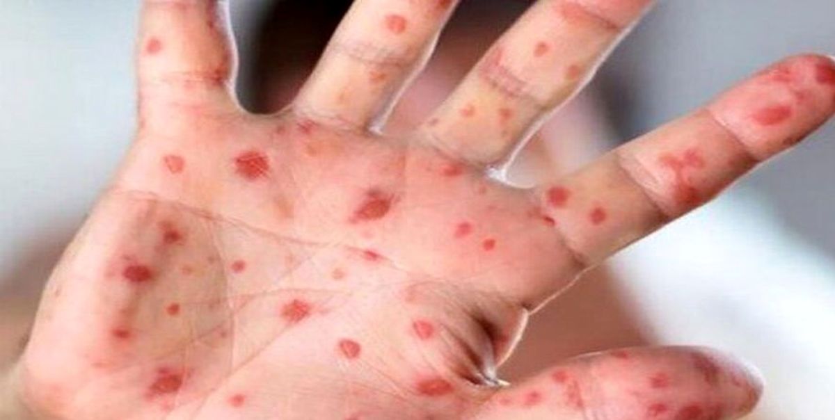 شناسایی یک کودک مبتلا به سرخک در قم