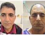 بهترین روش کاشت مو با تراکم بالا برای افرادی با بانک موی ضعیف