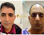 بهترین روش کاشت مو با تراکم بالا برای افرادی با بانک موی ضعیف