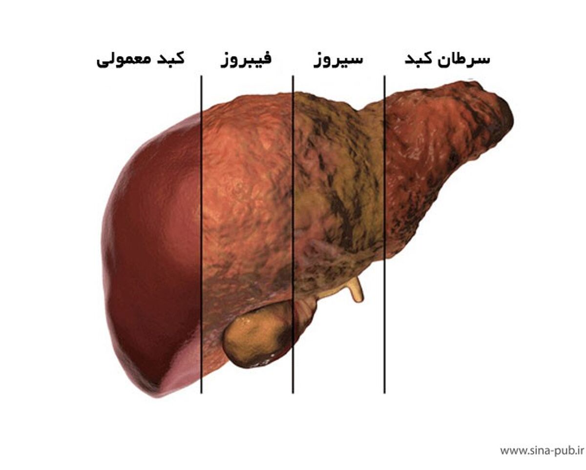 علائم بیماری کبد چرب را بشناسید