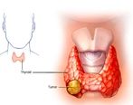 سرطان تیروئید چیست : + درمان آن