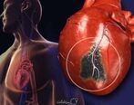 معجزه درمان برای جلوگیری از سکته قلبی + ویدئو 
