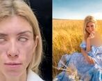 صورت ملکه زیبایی روس نابود ش| عکس های باورنکردنی