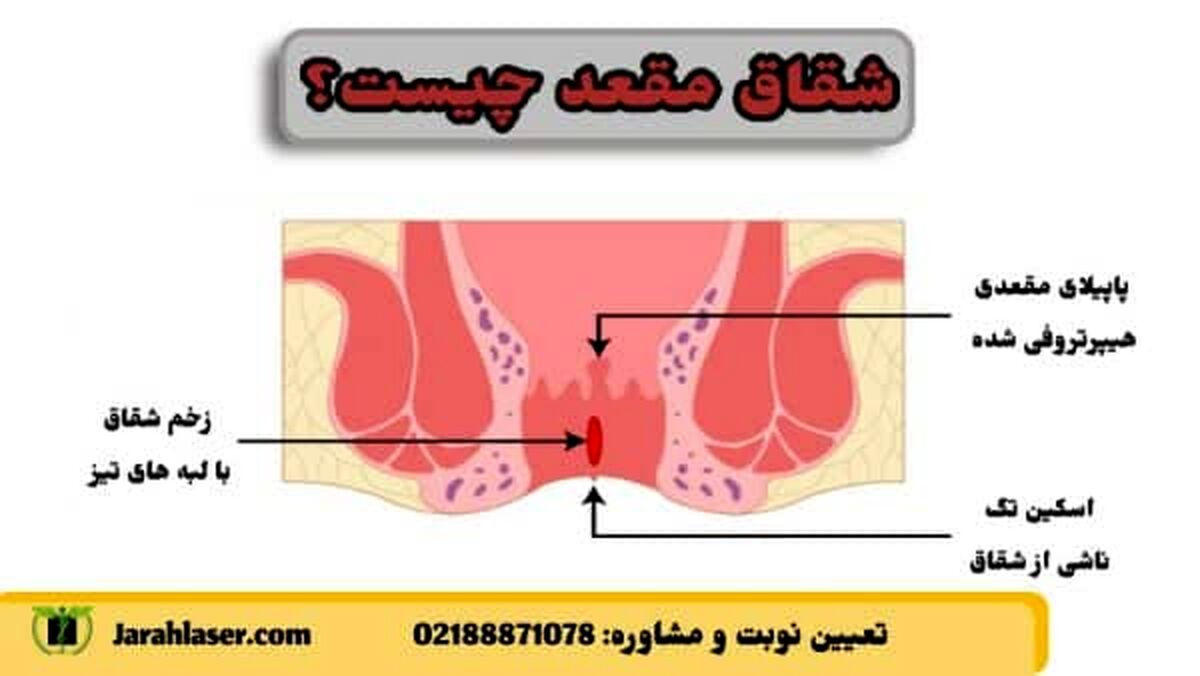 زخم مقعد در اثر یبوست نشانه چیست و چگونه درمان میشود؟